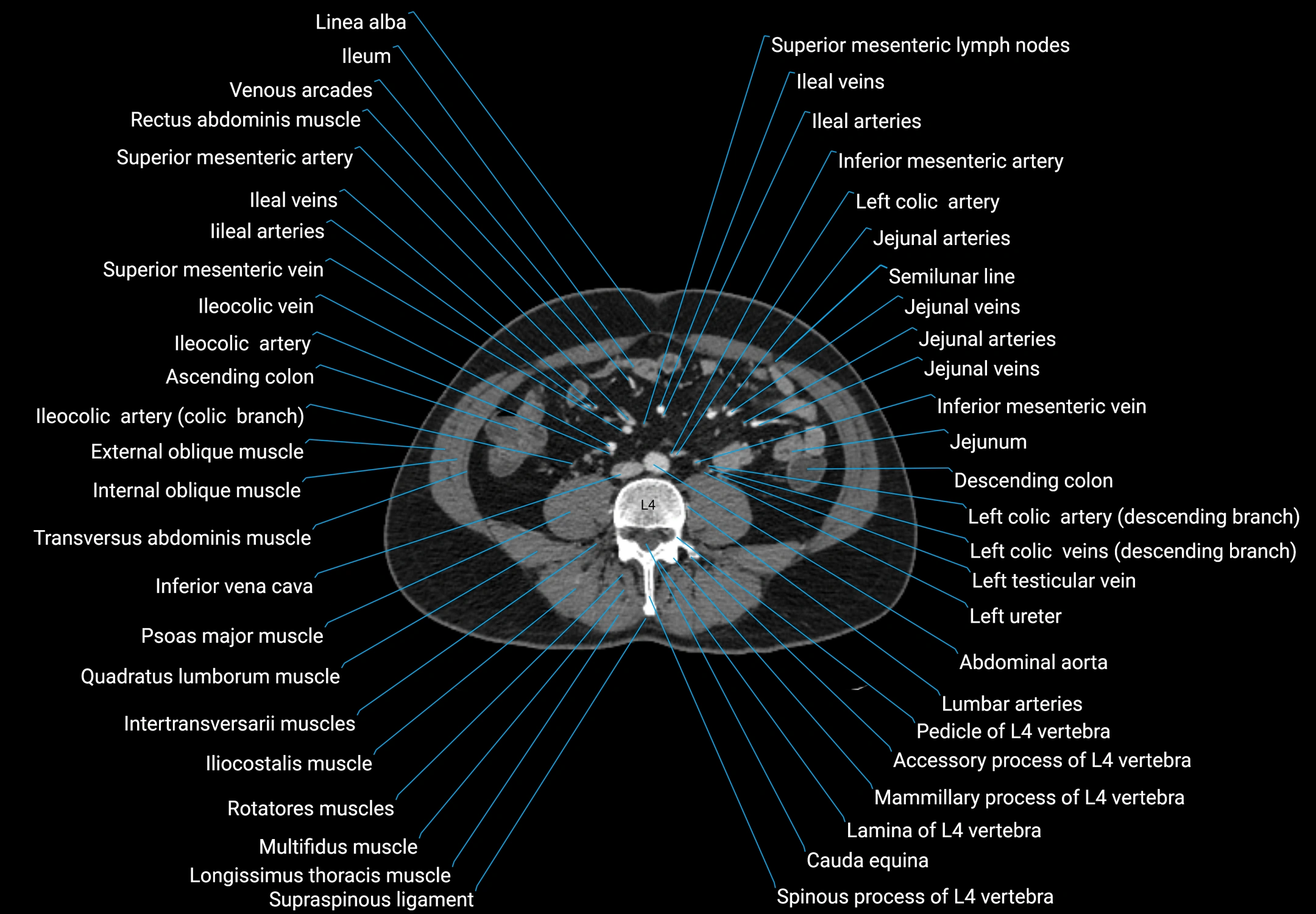 CT male pelvis axial cross sectional anatomy labelled radiology image -00110.webp